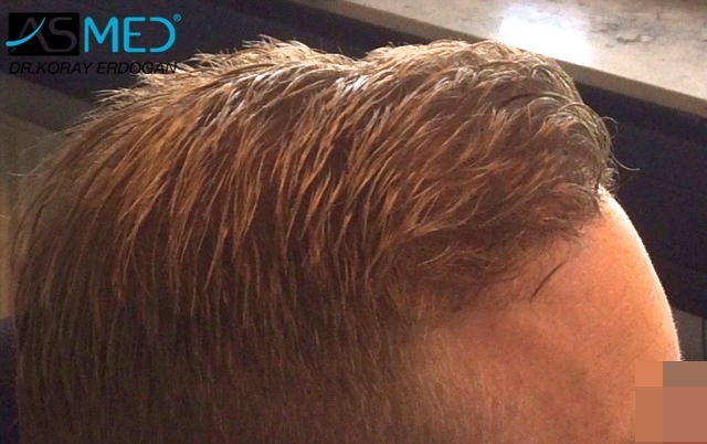 Norwood3 2810-grafts-FUE-Repair file_zpsf416bf83