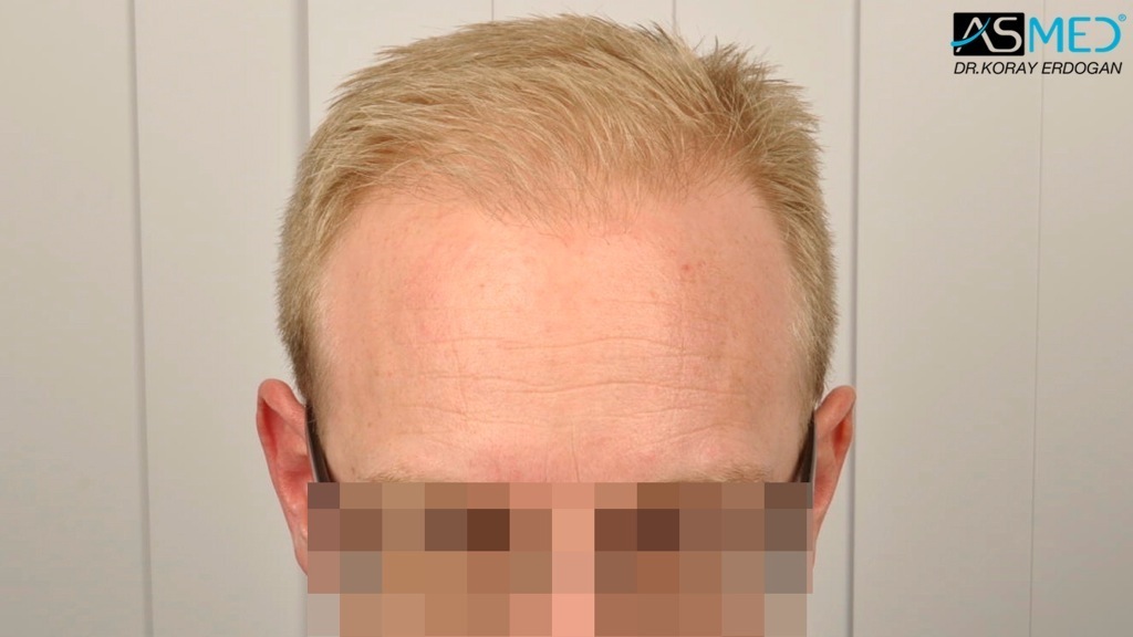 Norwood3 2810-grafts-FUE-Repair file_zpsf99e2b4c