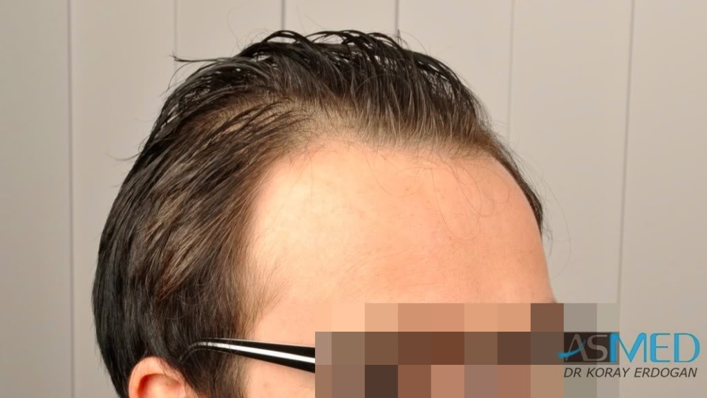 Norwood3 3019-grafts-FUE-2 0cfe5460