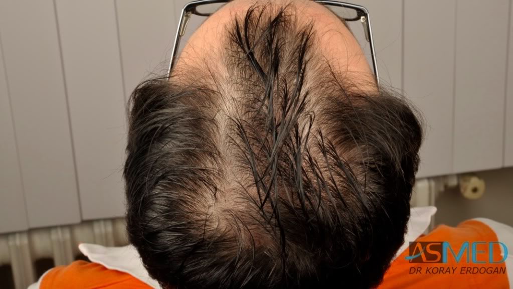 Norwood3 3019-grafts-FUE-2 170d2536