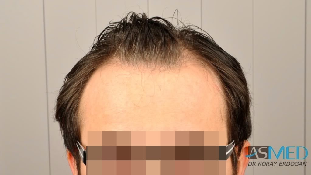 Norwood3 3019-grafts-FUE-2 19c3c74c