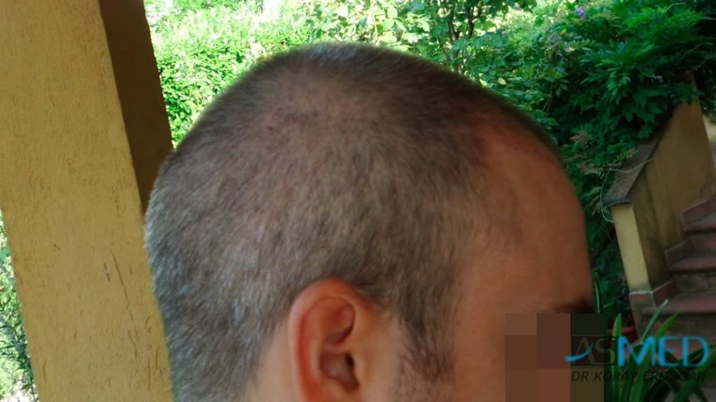 Norwood3 3019-grafts-FUE-2 333c86cc