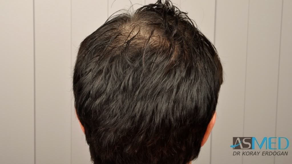 Norwood3 3019-grafts-FUE-2 4109a0b9