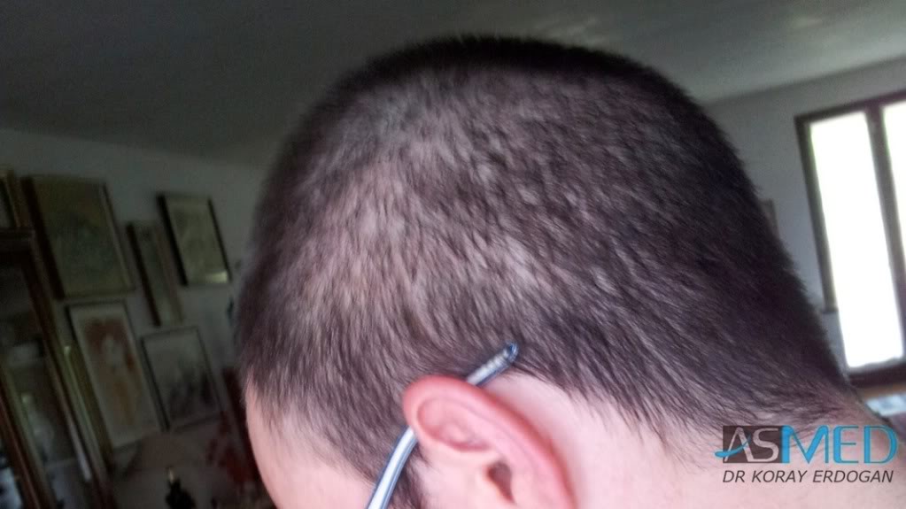 Norwood3 3019-grafts-FUE-2 480cec3c