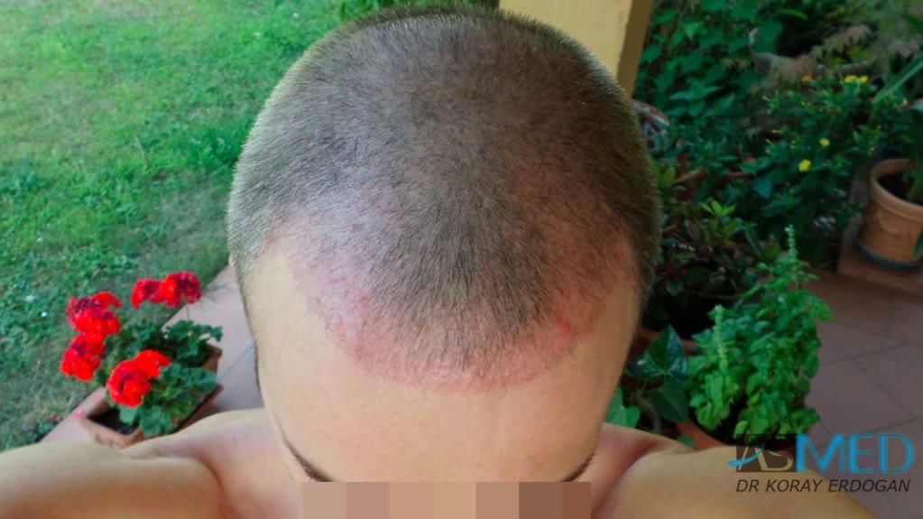 Norwood3 3019-grafts-FUE-2 533d2730