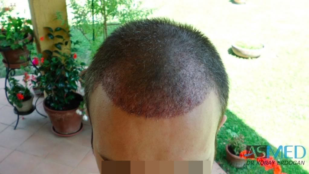 Norwood3 3019-grafts-FUE-2 56ab03ca