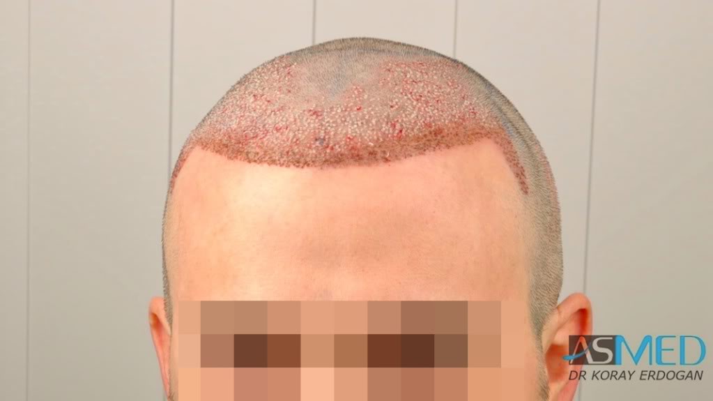 Norwood3 3019-grafts-FUE-2 76a5bc5a
