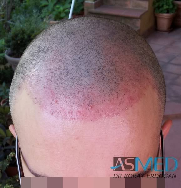 Norwood3 3019-grafts-FUE-2 7f7947c8
