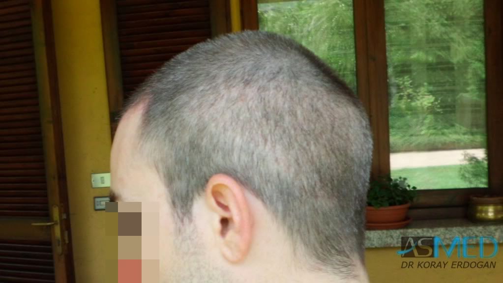 Norwood3 3019-grafts-FUE-2 86c5131e