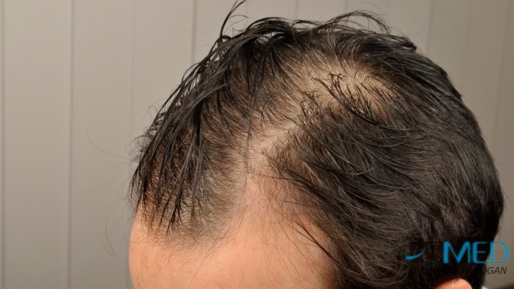 Norwood3 3019-grafts-FUE-2 9a7359b4