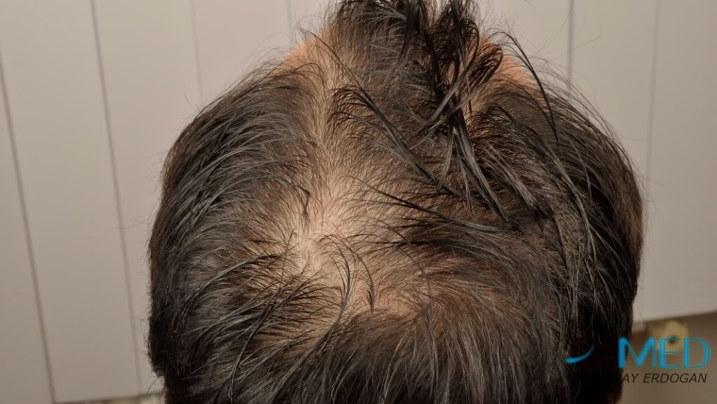 Norwood3 3019-grafts-FUE-2 9e9eff41