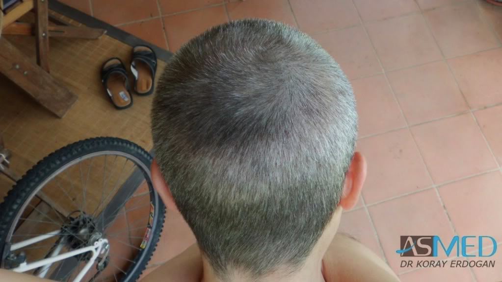 Norwood3 3019-grafts-FUE-2 a26e75d9