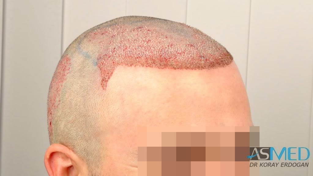 Norwood3 3019-grafts-FUE-2 ae60c43e