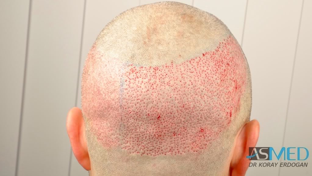 Norwood3 3019-grafts-FUE-2 c844509b