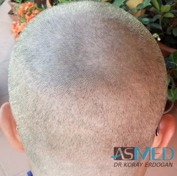 Norwood3 3019-grafts-FUE-2 ca237470