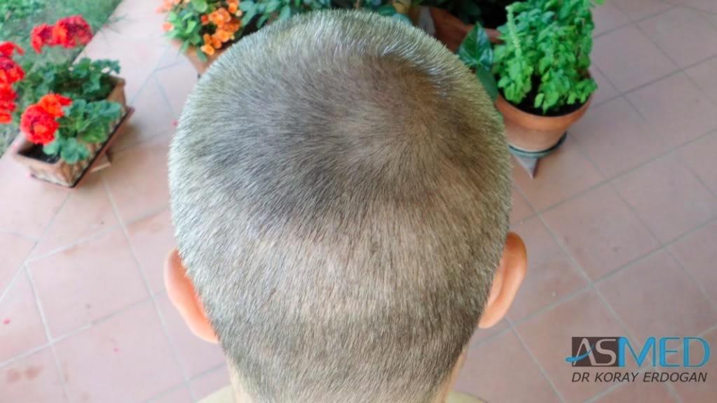 Norwood3 3019-grafts-FUE-2 dd6e7815