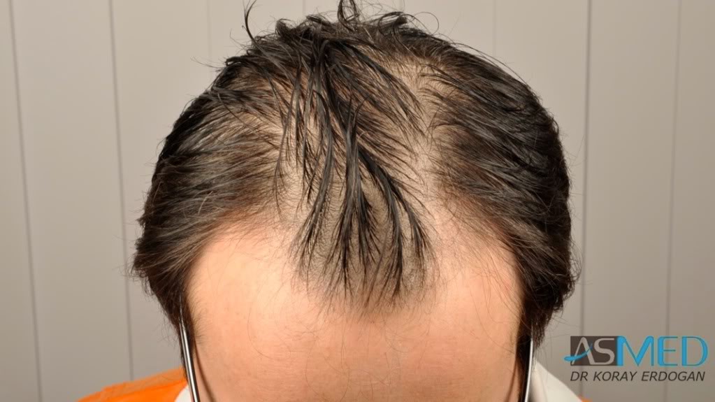 Norwood3 3019-grafts-FUE-2 dfbaf982