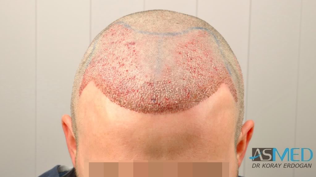 Norwood3 3019-grafts-FUE-2 e000b1b1