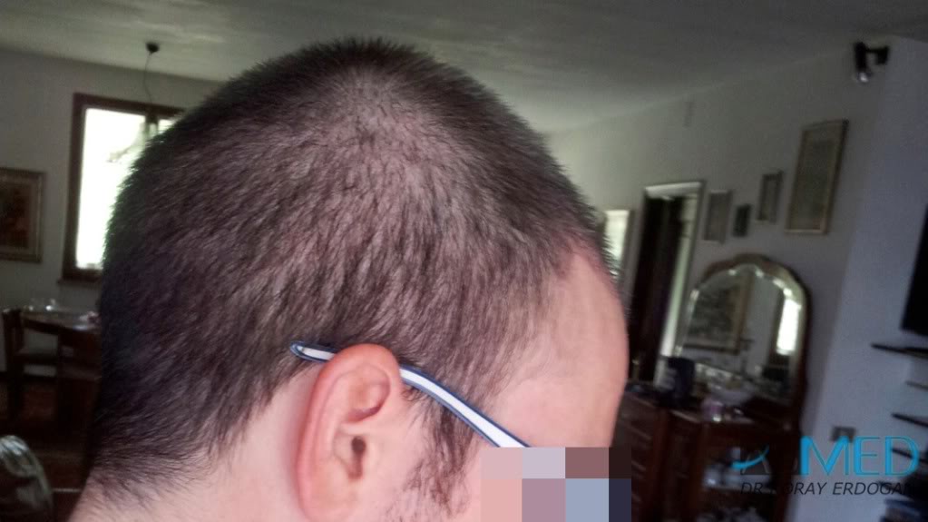 Norwood3 3019-grafts-FUE-2 e22c3624