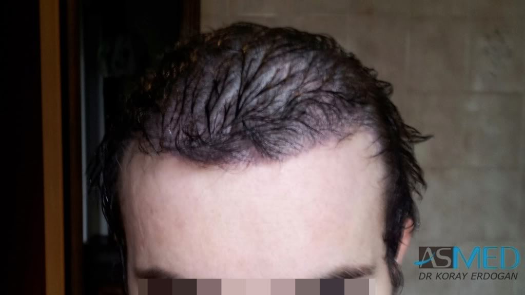 Norwood3 3019-grafts-FUE-2 file-1