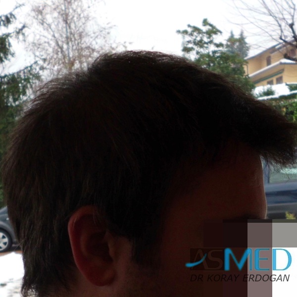 Norwood3 3019-grafts-FUE-2 file-10