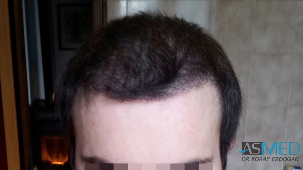 Norwood3 3019-grafts-FUE-2 file-2