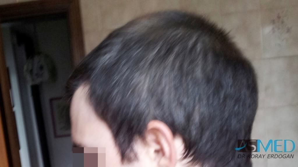 Norwood3 3019-grafts-FUE-2 file-3