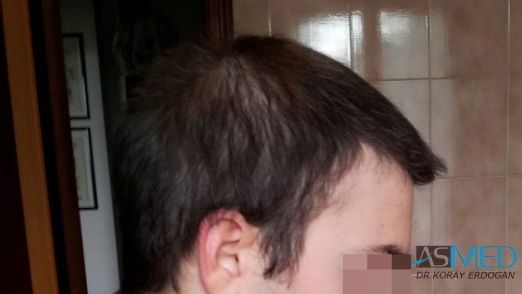 Norwood3 3019-grafts-FUE-2 file-4