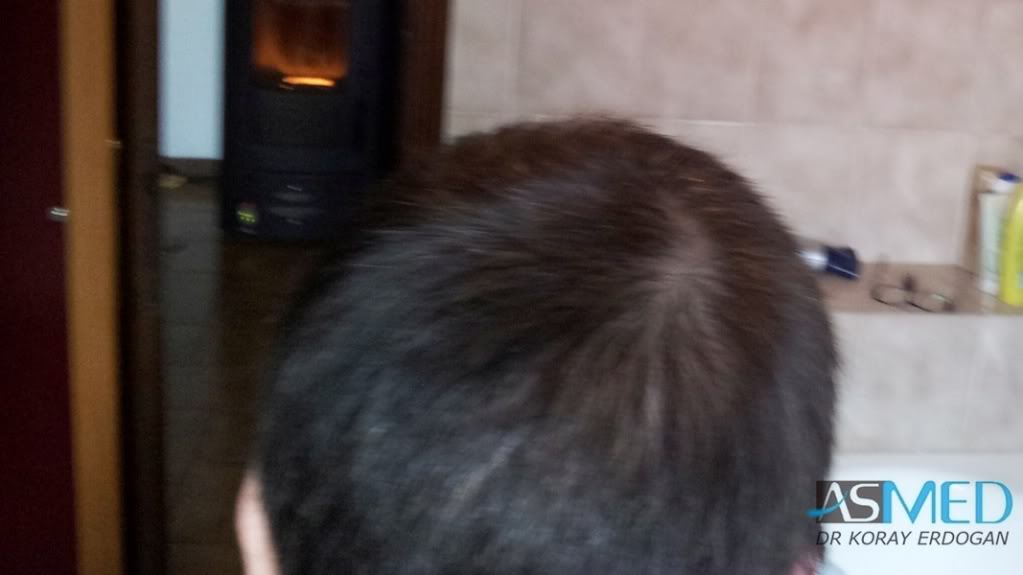Norwood3 3019-grafts-FUE-2 file-5