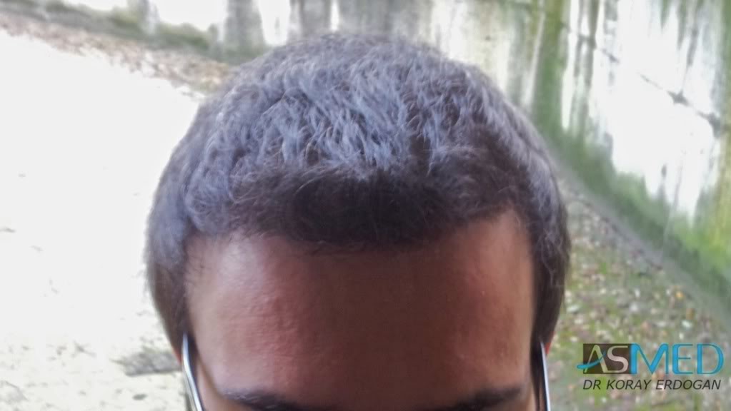 Norwood3 3019-grafts-FUE-2 file-7