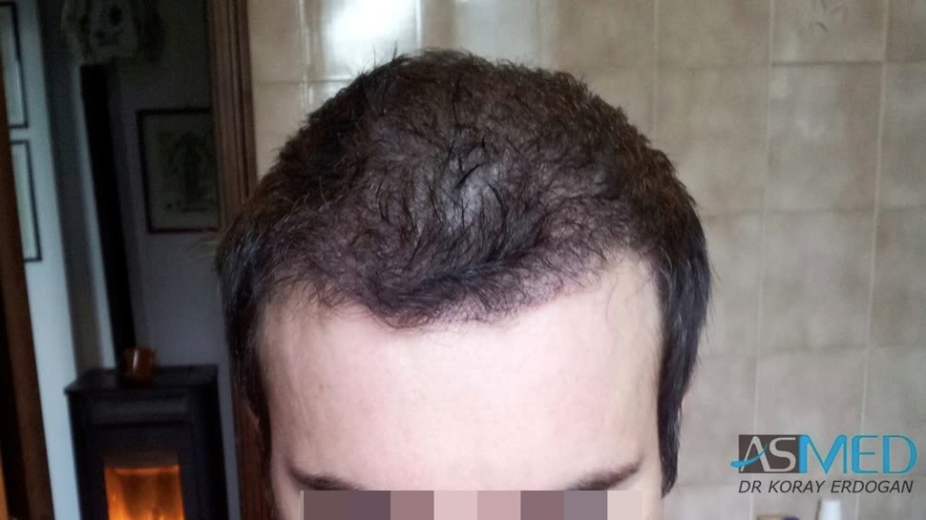 Norwood3 3019-grafts-FUE-2 file