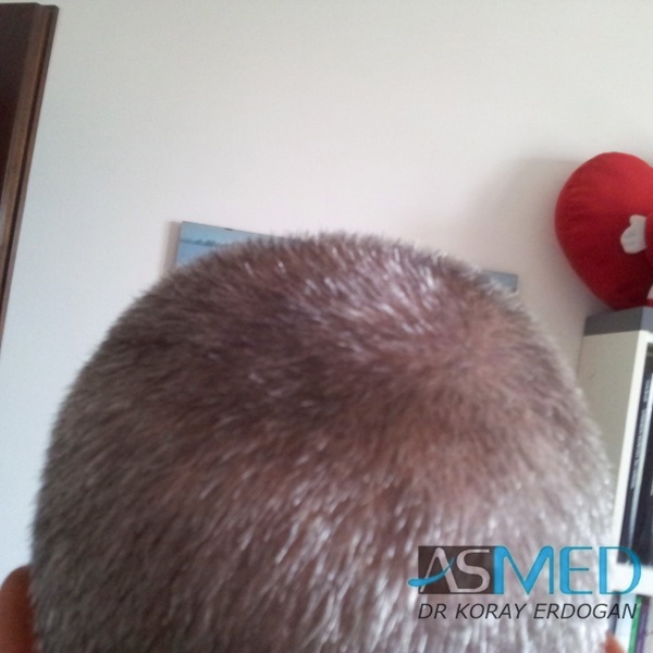 Norwood3 3019-grafts-FUE-2 file_zps034587bc