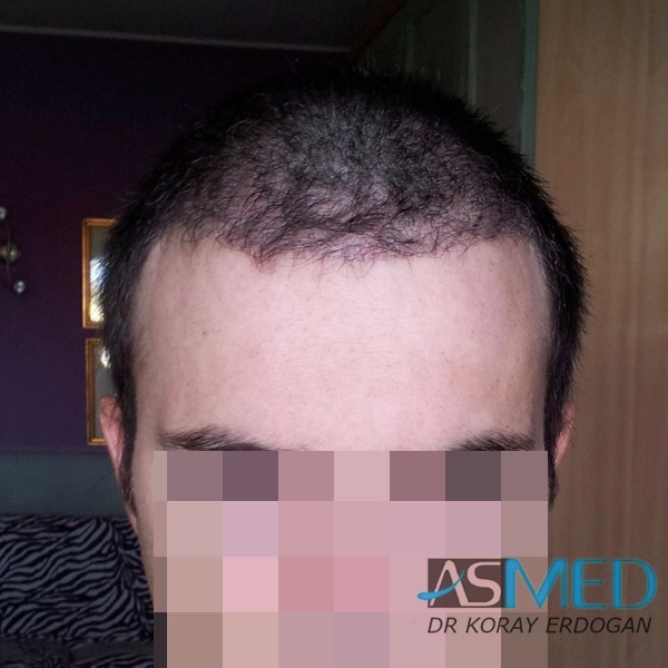 Norwood3 3019-grafts-FUE-2 file_zps2b073c89