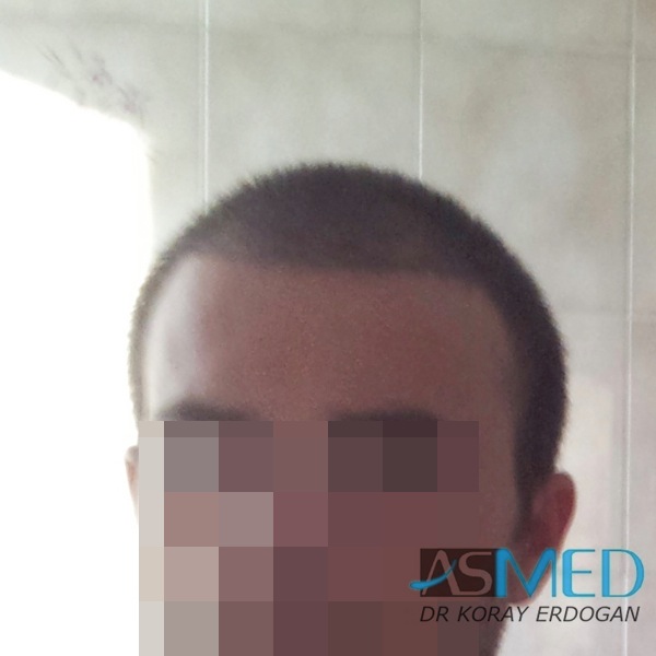 Norwood3 3019-grafts-FUE-2 file_zps3f6b0181
