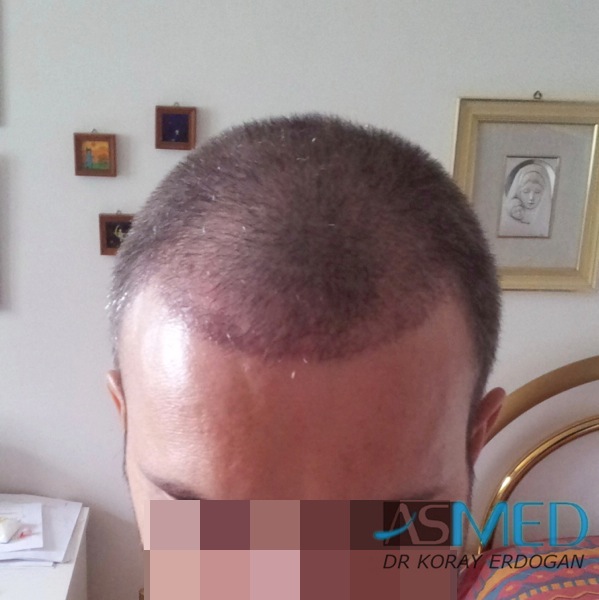 Norwood3 3019-grafts-FUE-2 file_zps5fcfb8cf