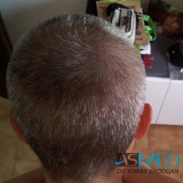 Norwood3 3019-grafts-FUE-2 file_zps663b968e