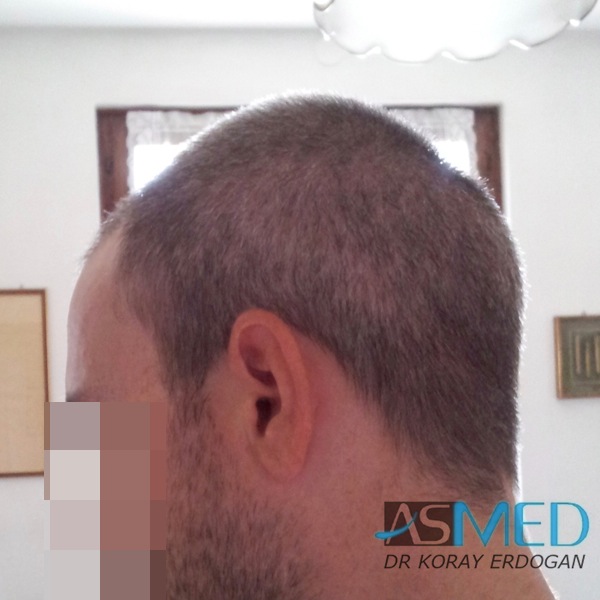 Norwood3 3019-grafts-FUE-2 file_zps68a84624