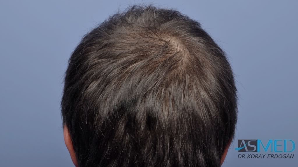 Norwood3 3019-grafts-FUE-2 file_zps6ed50cda