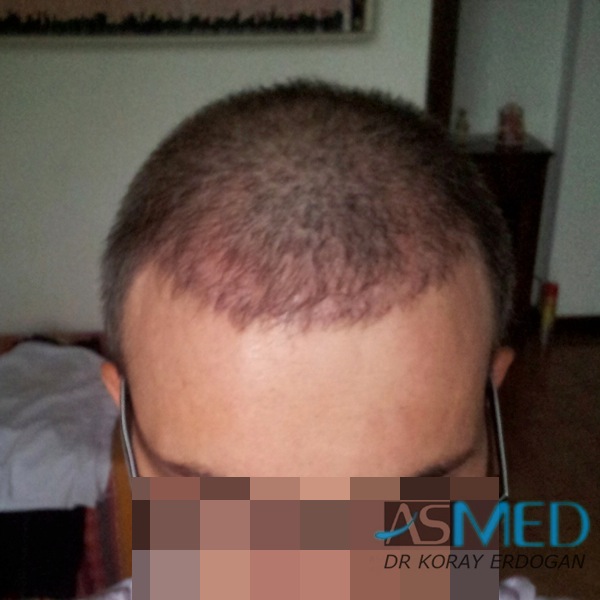 Norwood3 3019-grafts-FUE-2 file_zps70f7678c