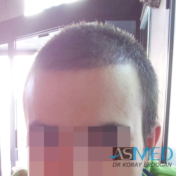 Norwood3 3019-grafts-FUE-2 file_zps8dbc8835