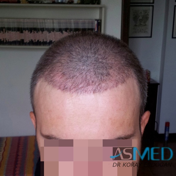 Norwood3 3019-grafts-FUE-2 file_zps9481a9f8