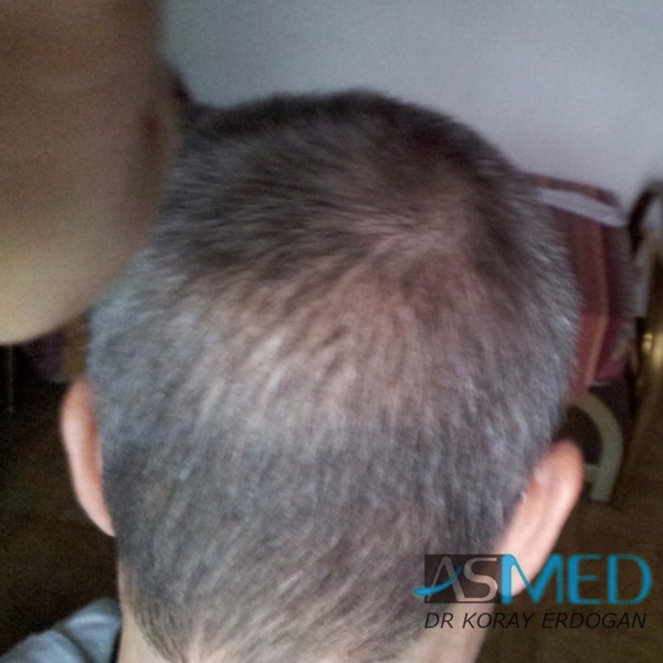 Norwood3 3019-grafts-FUE-2 file_zps94a76070