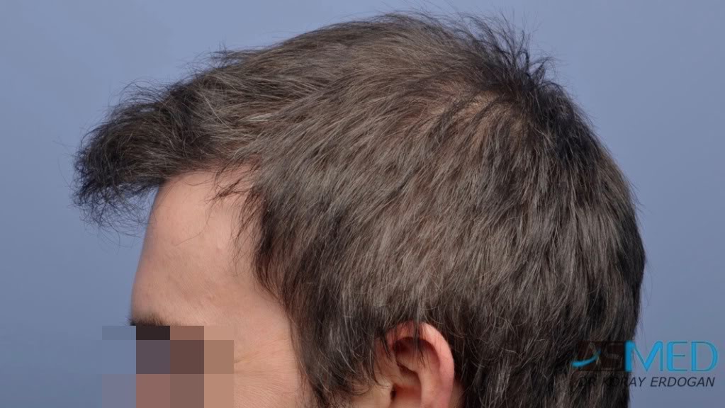 Norwood3 3019-grafts-FUE-2 file_zpsa4e3b151
