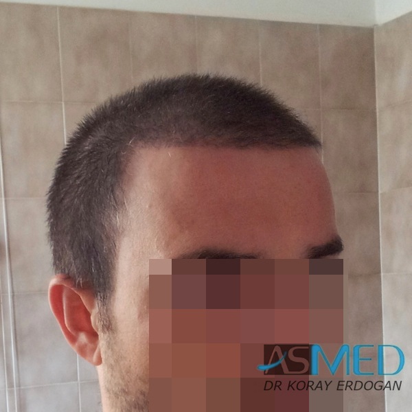 Norwood3 3019-grafts-FUE-2 file_zpsbea23251