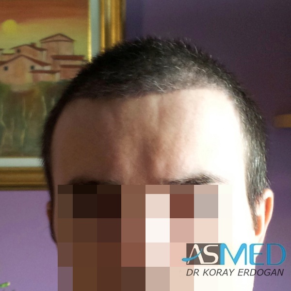 Norwood3 3019-grafts-FUE-2 file_zpsceda5190