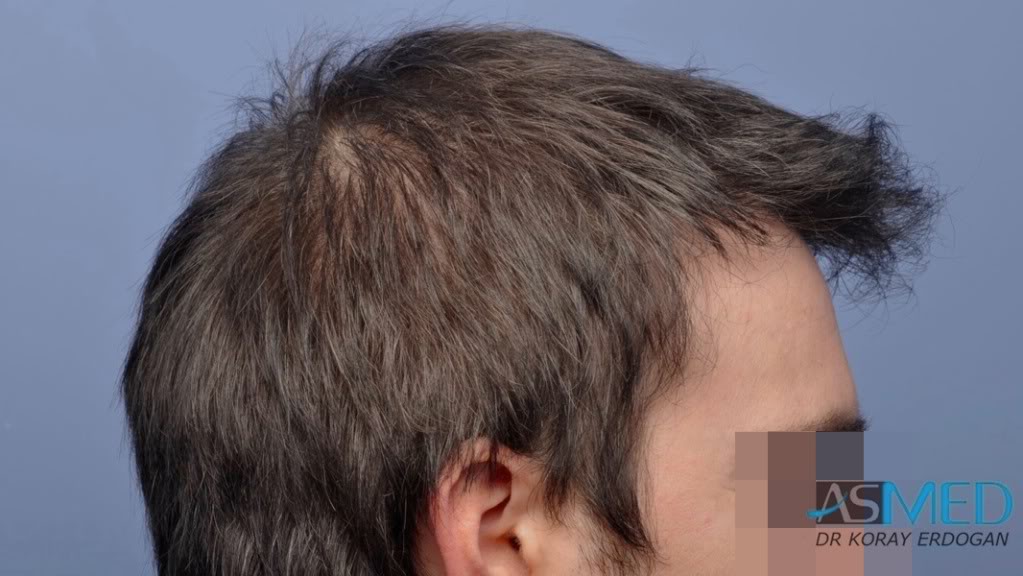 Norwood3 3019-grafts-FUE-2 file_zpsf306c550