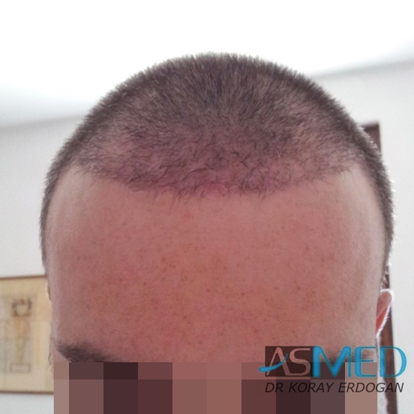 Norwood3 3019-grafts-FUE-2 file_zpsf326a817