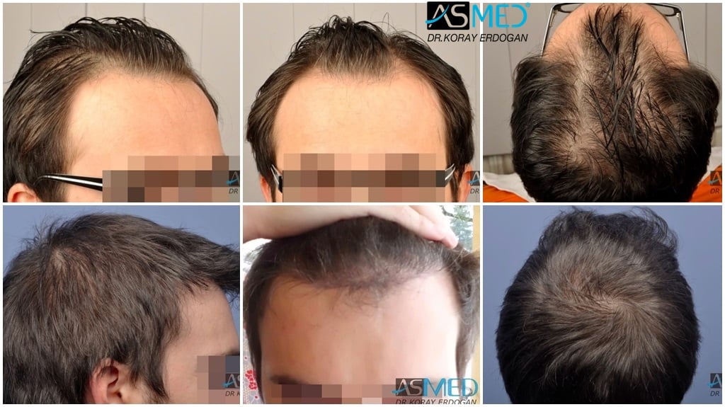 3019-grafts-FUE-2 gallery