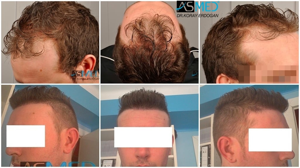 3230-grafts-FUE gallery