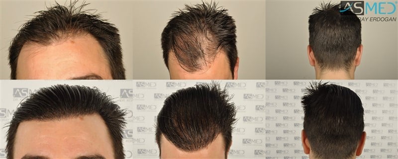 3408-grafts-FUE gallery